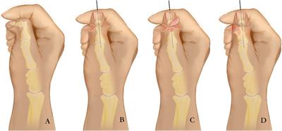 Reconstruction of radial deviation after preaxial polydactyly surgery: use of an ulnar fascial flap